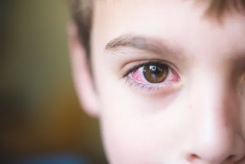 Cómo darte cuenta que tu hijo tiene conjuntivitis y cuánto dura el tratamiento