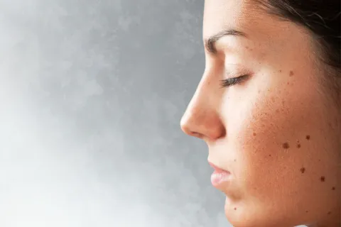 Cómo detectar un melanoma.