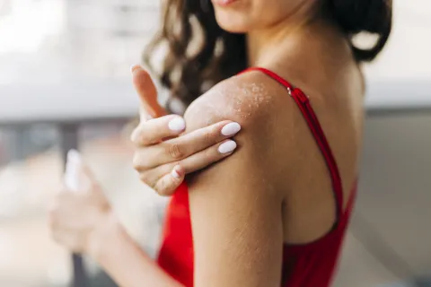 Piel post playa: tips para sanar manchas, sequedad y deshidratación.