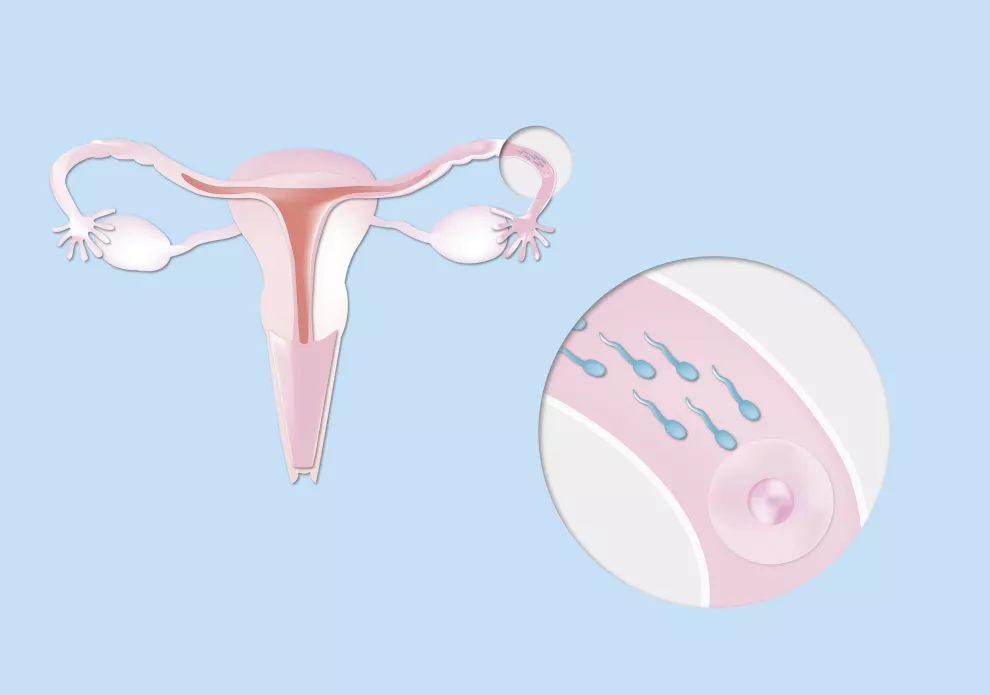 La vitrificación consiste en extraer óvulos cuando la mujer es joven como para tener en abundancia y calidad, congelarlos, mantenerlos el tiempo que sea necesario, y usarlos cuando desee un embarazo.